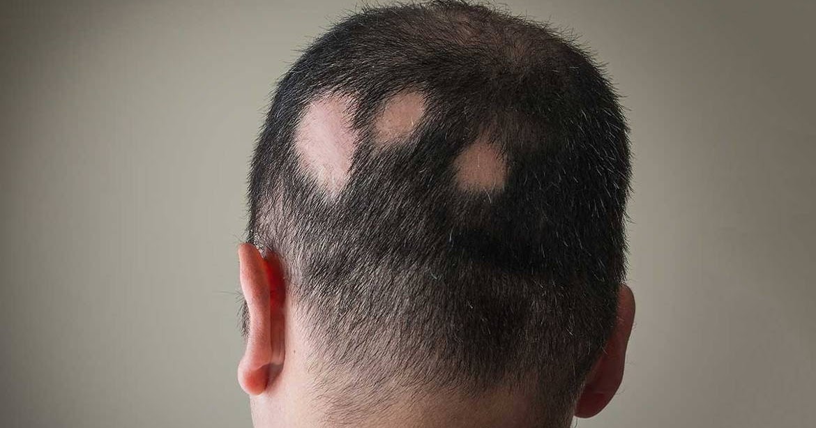 Alopecia